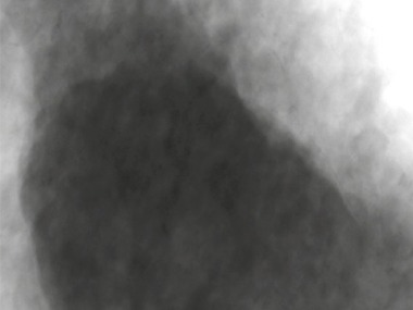 Obr. 2b Pklad projekc (2D RTG snmk) zrna kameniva pozench v hlu 90. Projekce pro ROI tomografii zaclenou na sted vzorku s rozlienm 5,05 μm / pixel.